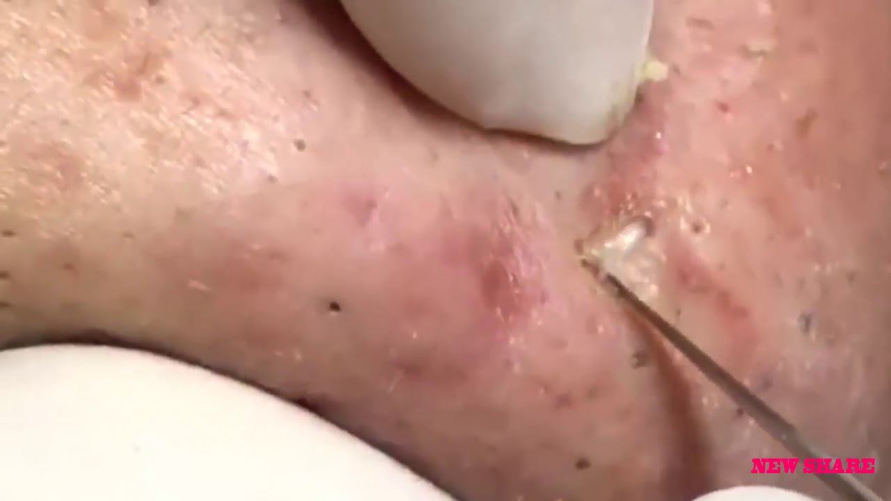 New Share Black Head Removal, Black Head On Face, Skill Remove Ep23 смотреть онлайн