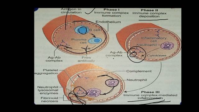 Hypersensitivity Reaction Part-2 | Type 3(immune complex mediated) | Type 4(cell mediated&delayed) смотреть онлайн