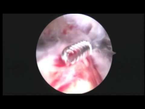 JF R rotator cuff repair, biceps tenodesis 9.15.14 смотреть онлайн