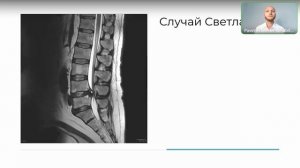 Реабилитация после операции грыжи поясницы клинический случай