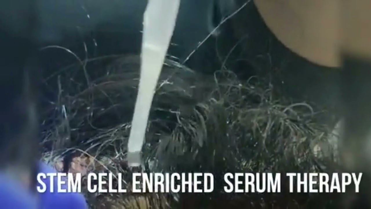 Hair Regrowth and Laser Treatments смотреть онлайн