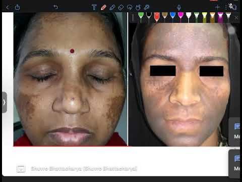 FINAL YEAR DERMA ALL SPOTTER IN 20 MIN смотреть онлайн