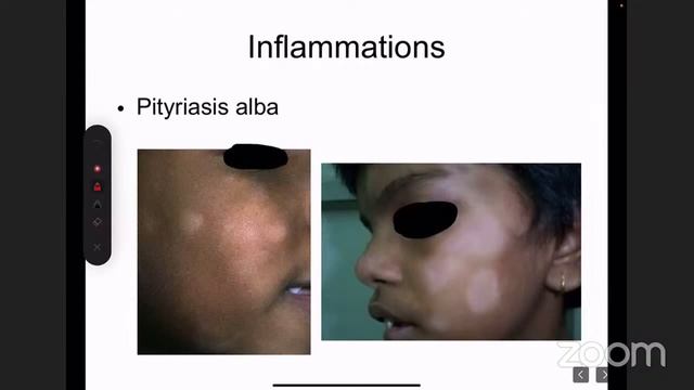 HYPOPIGMENTED LESIONS смотреть онлайн