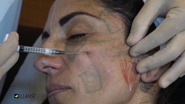 Ellansé® Full face injection_Dr. F. de Melo смотреть онлайн
