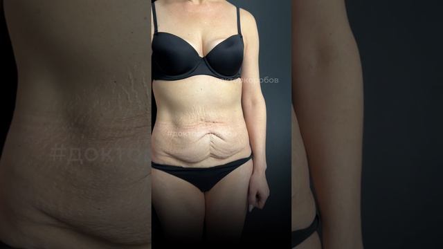 Идеальный живот с помощью комплексной операции смотреть онлайн