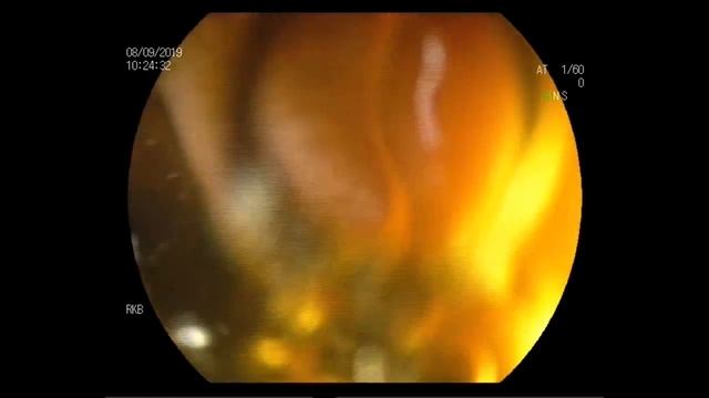 Дефект ДПК смотреть онлайн