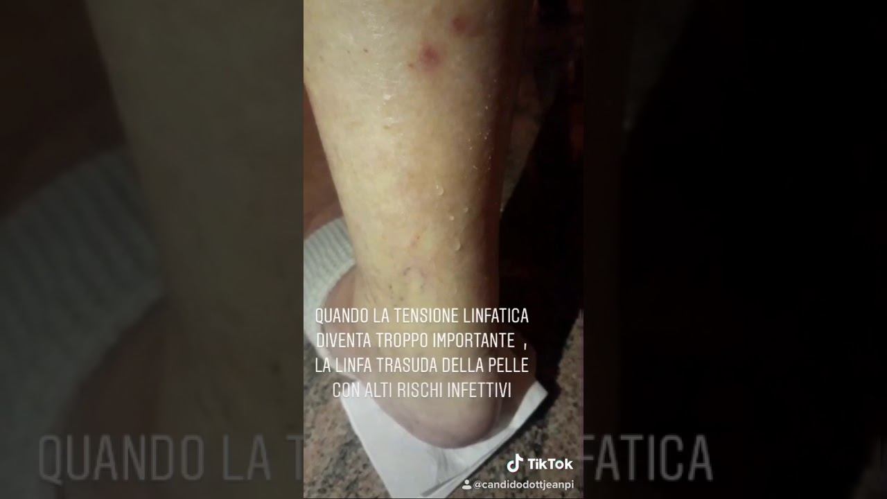 sistema linfatico, linfatismo, Cardoso da Cruz Germania specialista in Vodder смотреть онлайн