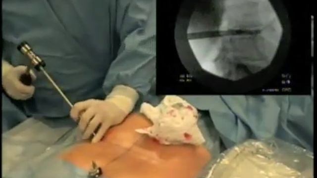 Lumbar Endoscopic Discectomy www.njspinerehab.com смотреть онлайн