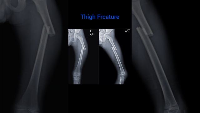 Displace Fracture of Femur Bone@radiologylecture9780 смотреть онлайн
