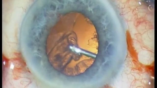 Bonus video: Lens injury after intravitreal injection смотреть онлайн