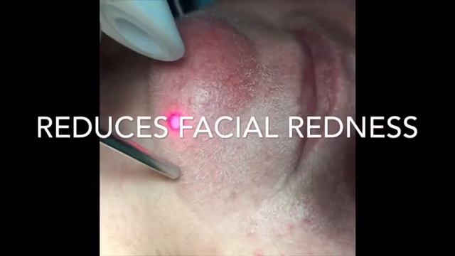 Fotona 4D LaserLift FaciaRedness Rosacea Brisbane смотреть онлайн