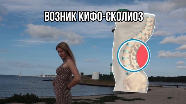 Лечение сколиоза, кифоза, лордоза, чтобы вернуть талию и уменьшить живот