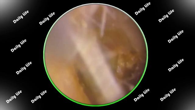 耳垢の除去 - Ear Wax Removal (EP-46) смотреть онлайн