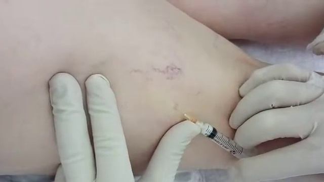 Склеротерапия смотреть онлайн