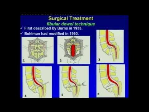Dr.Azmi hamzaoglu - Treatment of High grade Spondylolisthesis. смотреть онлайн