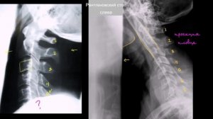 Адекватность рентгеновского снимка шейного отдела позвоночника в боковой проекции