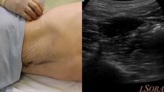 LSORA: Ultrasound Guided Quadratus Lumborum Block Tutorial смотреть онлайн