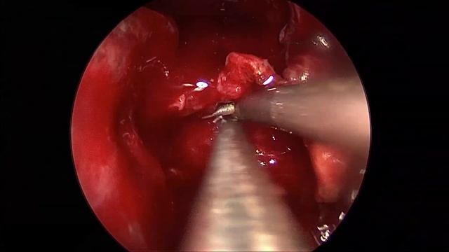 Huge pituitary tumor, right ICA encase with 3rd ventricule extenstion, EEA, 202107 смотреть онлайн