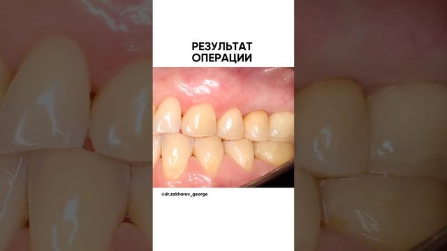Закрываем оголившиеся корни зубов смотреть онлайн