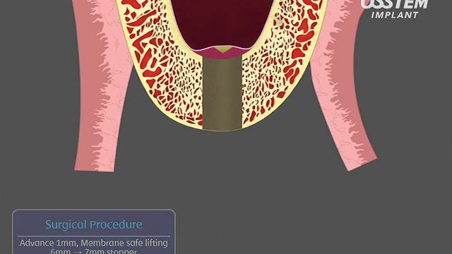 OSSTEAM Implant