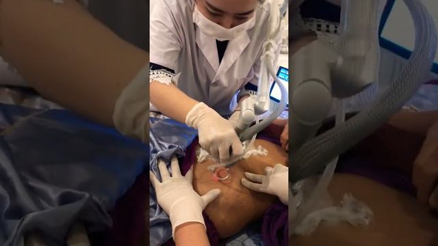 Stretch mark removal on belly using Fotona 4D laser смотреть онлайн