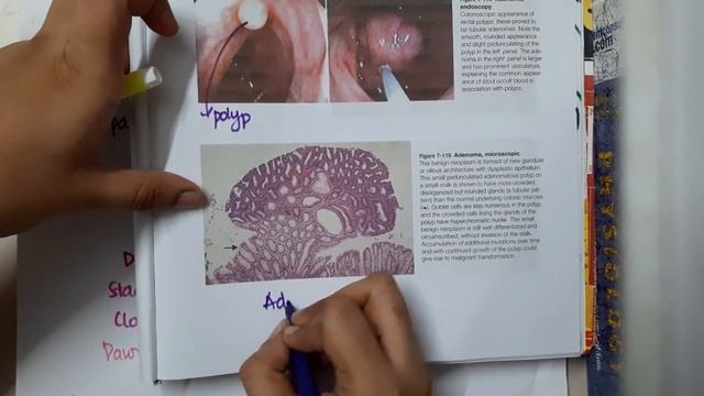 Small Intestinal Adenoma mp4 смотреть онлайн