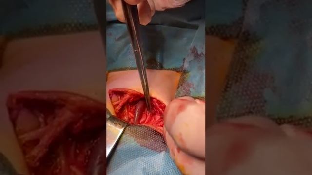 Neck anatomy after tumor removal смотреть онлайн