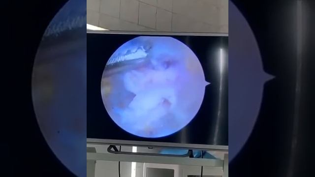 Удаление пяточной шпоры. ЧУЗ КБ _РЖД-Медицина смотреть онлайн