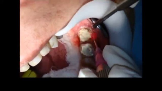 Gingival Troughing Diode Laser 980nm by DC International смотреть онлайн