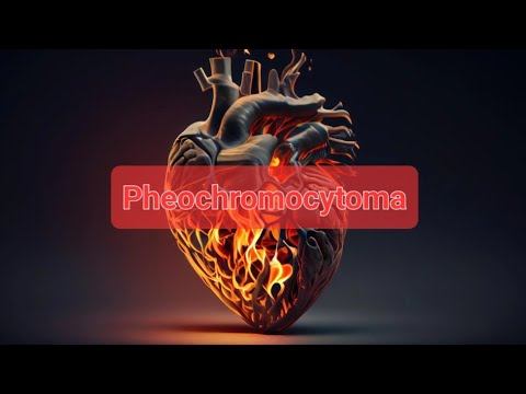 Pheochromocytoma ppt смотреть онлайн
