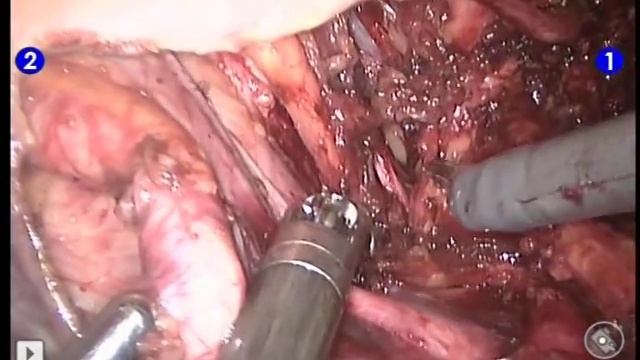 Robotic-assisted ilio-obturator lymphadenectomy смотреть онлайн