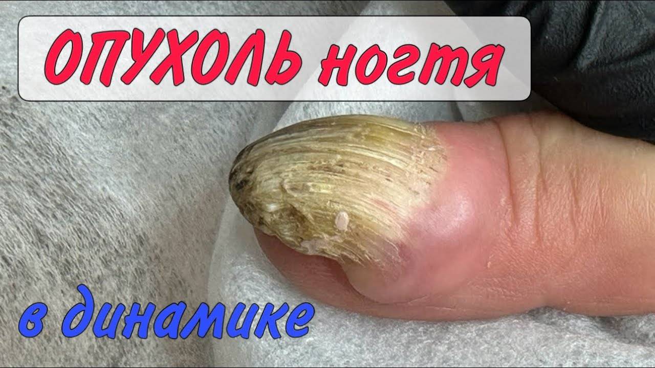 Опухоль на пальце_онихоматрикома_сложный случай смотреть онлайн