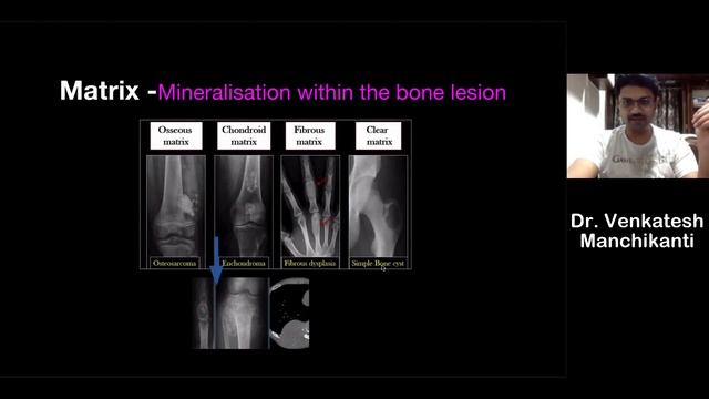 Imaging of Bone Tumors : Key Concepts | Dr. Venkatesh Manchikanti @ShadesofRadiology смотреть онлайн