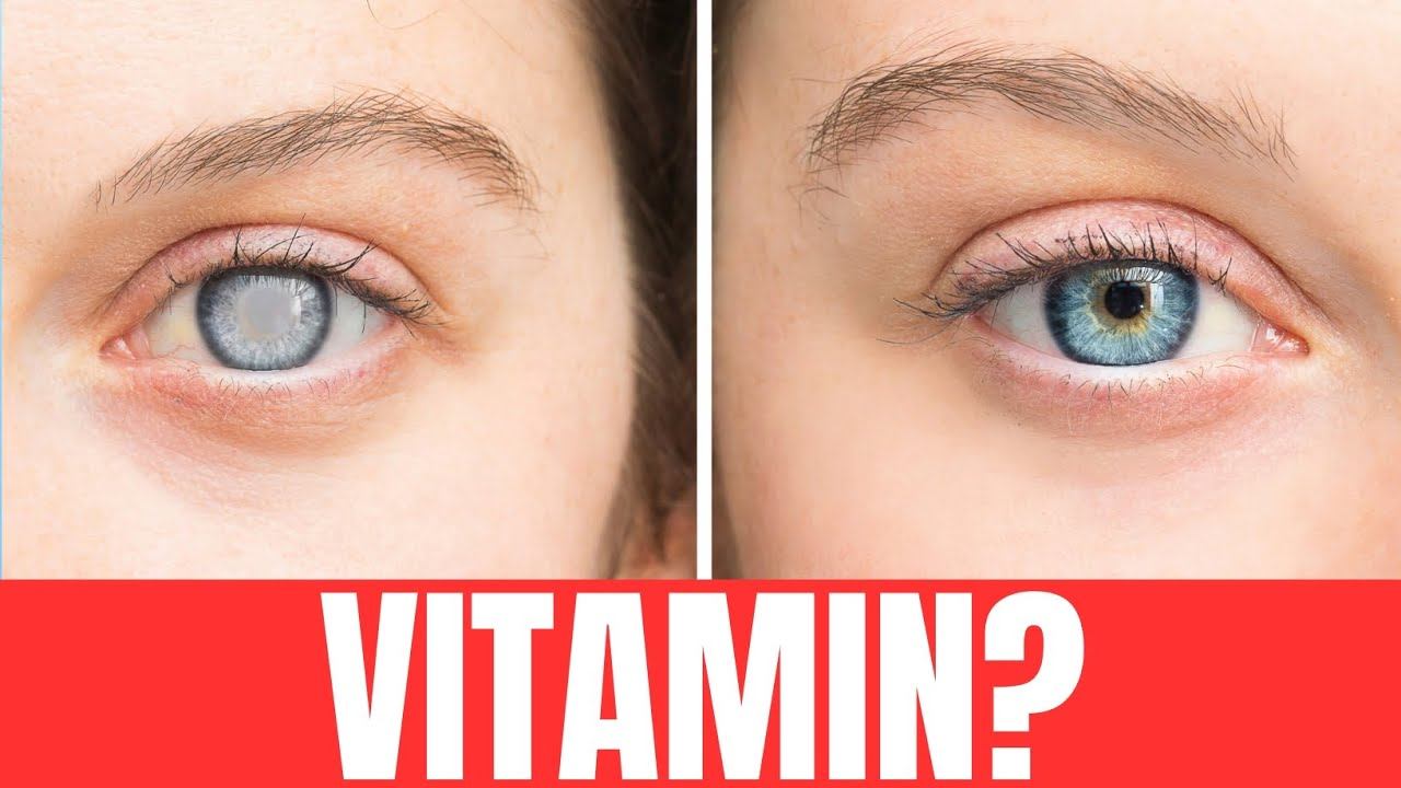 Najvažniji VITAMIN za sprečavanje KATARAKTE, SLJEPOĆE, MAKULARNE DEGENERACIJE... смотреть онлайн