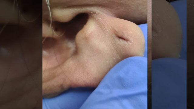 Corrección de Lesión por Aretes 👩⚕️👨⚕️ смотреть онлайн
