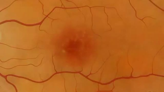 Макулодистрофия смотреть онлайн