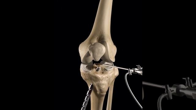 ACL Reconstruction.... смотреть онлайн