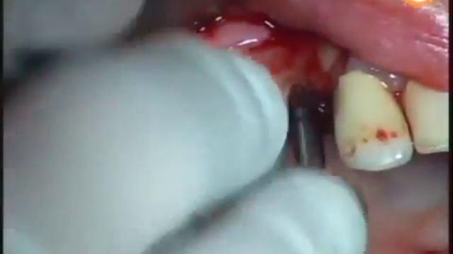 TS III SA implant, CAS KIT LAS KIT Dr Cho, Osstem Meeting 2011 смотреть онлайн