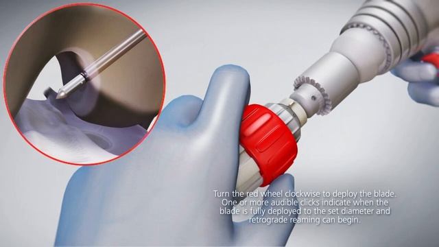 DePuy Synthes TWISTR Retrograde Reamer смотреть онлайн