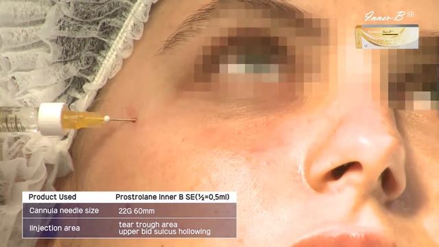Prostroline Inner B SE injection technique. смотреть онлайн
