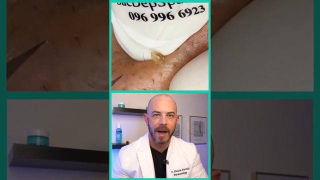Derm reacts to massive blackheads! #dermreacts #doctorreacts #bla#blackheadextraction смотреть онлайн