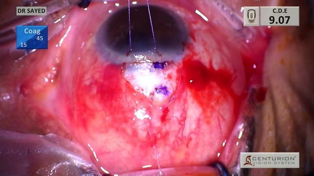 PreserFlo Microshunt with a thin conjunctiva смотреть онлайн