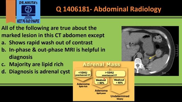 Adrenal adenoma Radiology - Algorithm to identify смотреть онлайн