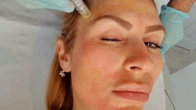 Anti Aging Dermapen with bespoke vitamins Plus Dermalux Led Light Therapy @bellezzacliniclondon смотреть онлайн