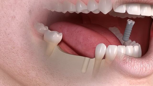 Straumann - Implant-borne multi-tooth treatment смотреть онлайн