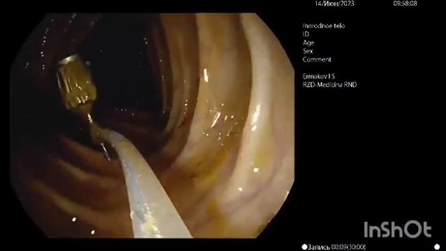 Я проглотил стоматологический инструмент смотреть онлайн