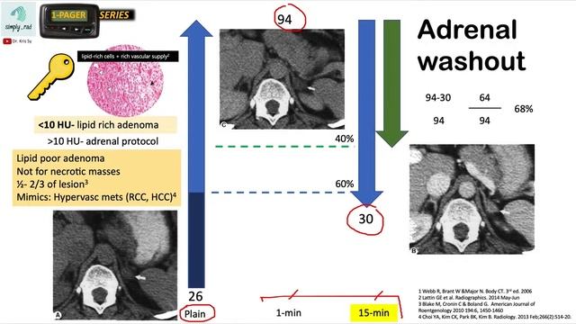 CT Adrenal Protocol (washout) 2/2 смотреть онлайн