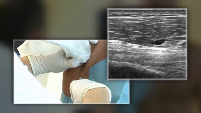 OSTENIL® Tendon injection 4/4: Biceps Brachii смотреть онлайн