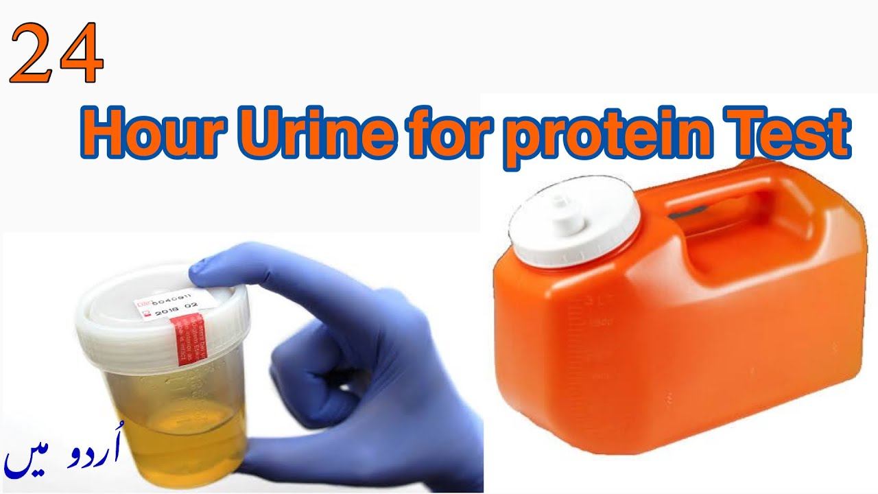 24-hour Urine Protein Test: Purpose, Procedure, and Results | 24-hour urine for protein test in urd смотреть онлайн