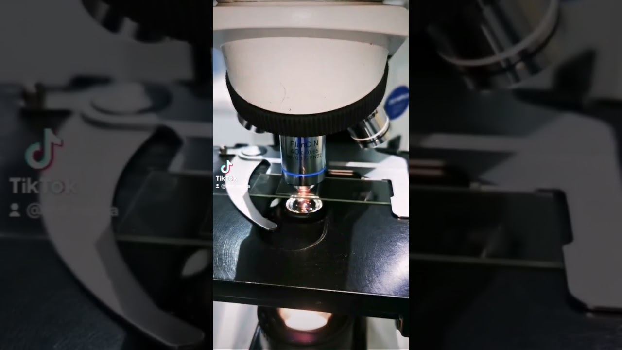 UTI under the microscope. Urinary Tract Infection PUS Cells. White blood cells #laboratory #urine m смотреть онлайн